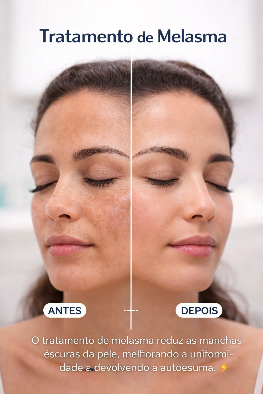 Tratamento para Melasma Curitiba
